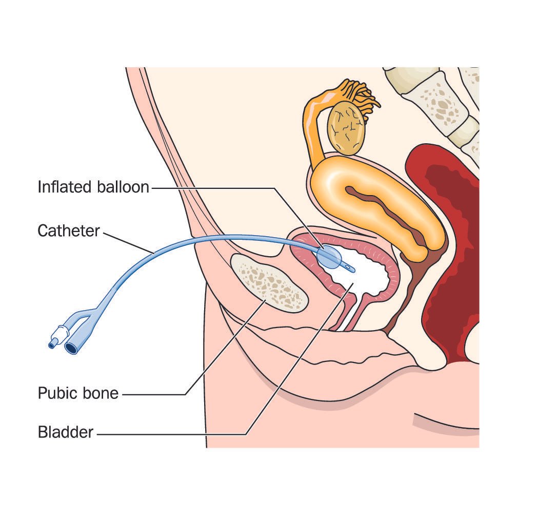 Female Patient Catheter Insertion Techniques